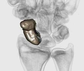 Scaphoid 3D Volar